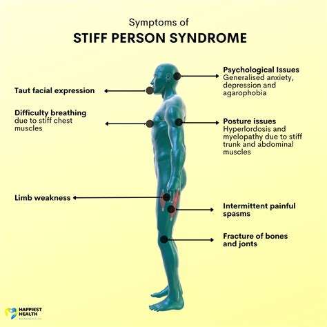 Stiff-person syndrome: What is it and how it’s treated